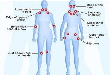 fibromyalgia-دیاگرام