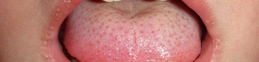 بیماری کاوازاکی