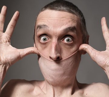 ​سندرم اهلرز دانلوس