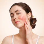 روماتیسم گونه ها و راش پروانه ای در لوپوس
