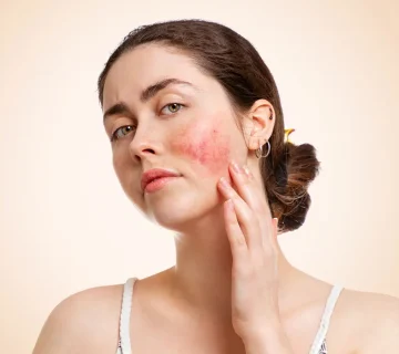 روماتیسم گونه ها و راش پروانه ای در لوپوس