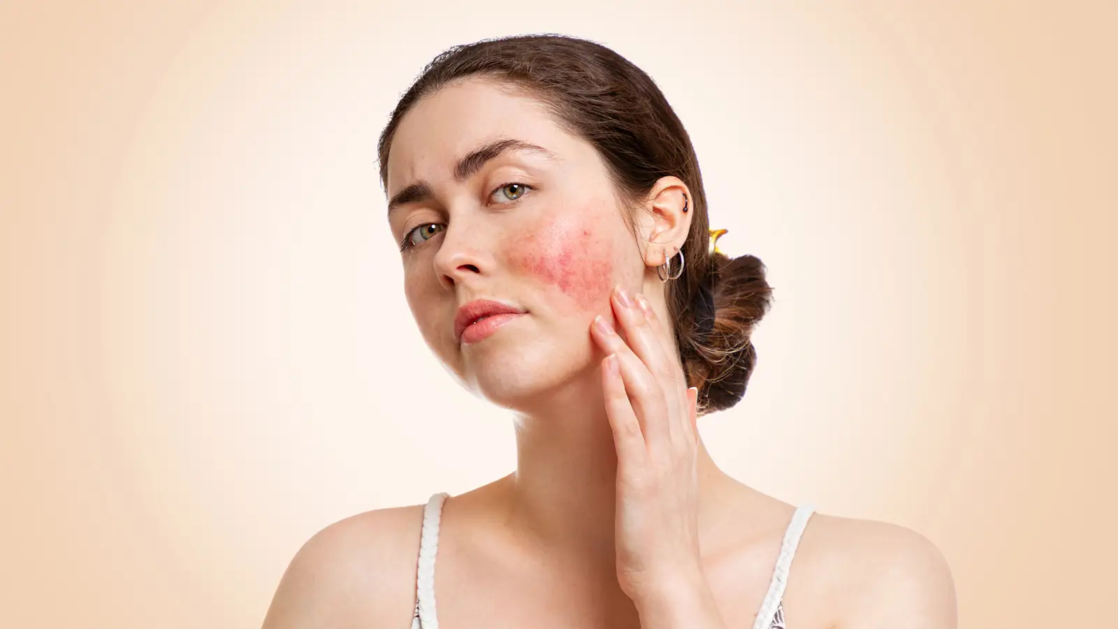 روماتیسم گونه ها و راش پروانه ای در لوپوس