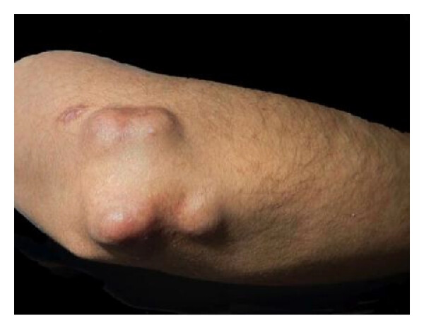 عکس ندول های روماتیسمی