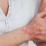 سندرم پوستی استیون جانسون