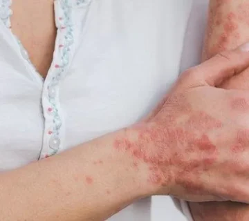 سندرم پوستی استیون جانسون