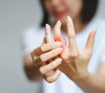 آرتریت روماتوئید سرونگاتیو