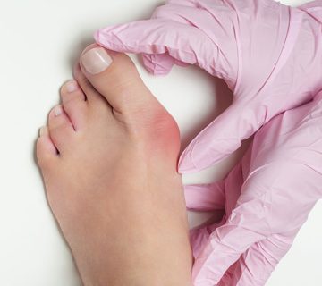 التهاب مفصل شست پا