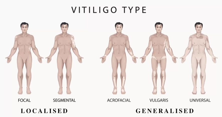انواع بیماری پیسی