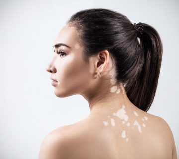 بیماری پیسی Vitiligo