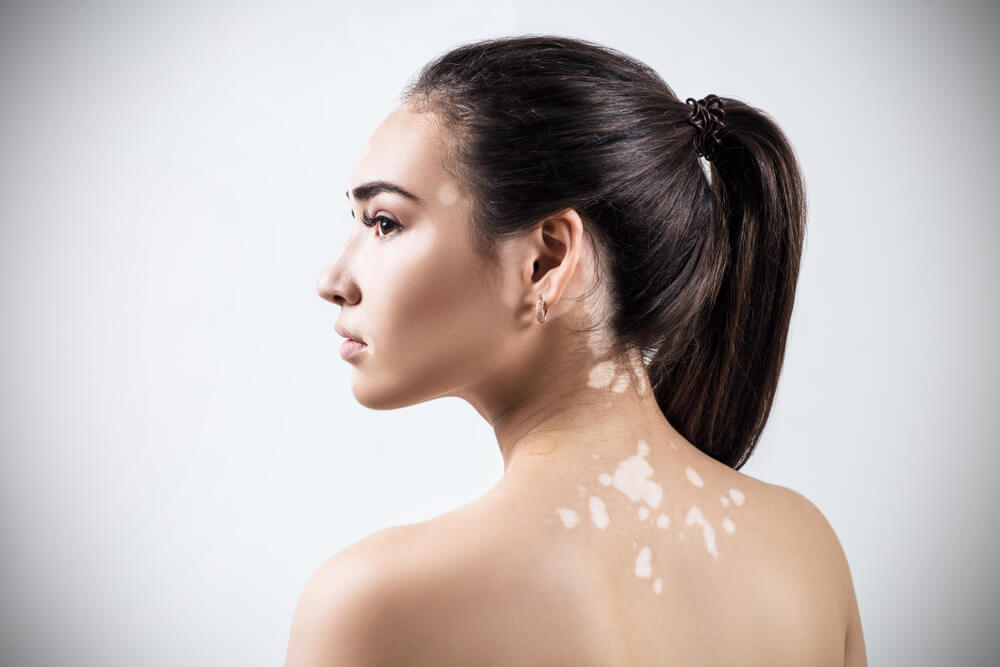 بیماری پیسی Vitiligo