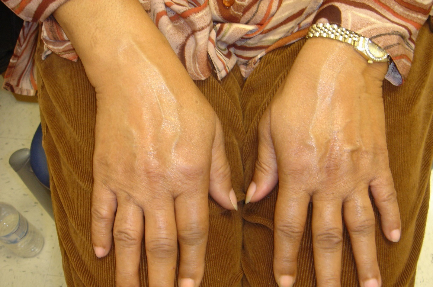 عکس آرتریت روماتوئید سرونگاتیو