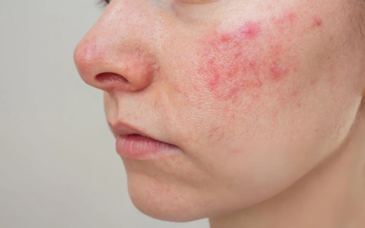 لوپوس اریتماتوز سیستمیک