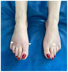 عکس پلی آرتریت ندوزا