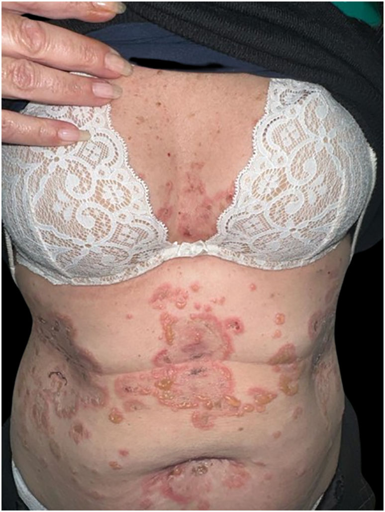 عکس پمفیگوس ولگاریس