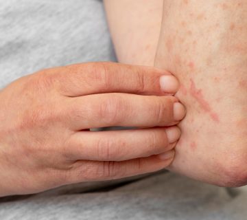 فتوسنسیویتی