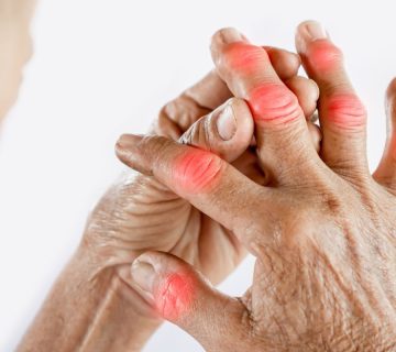 هورمون ها و روماتیسم مفصلی