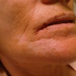 پلی آرتریت ندوزا