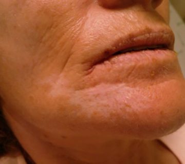 پلی آرتریت ندوزا