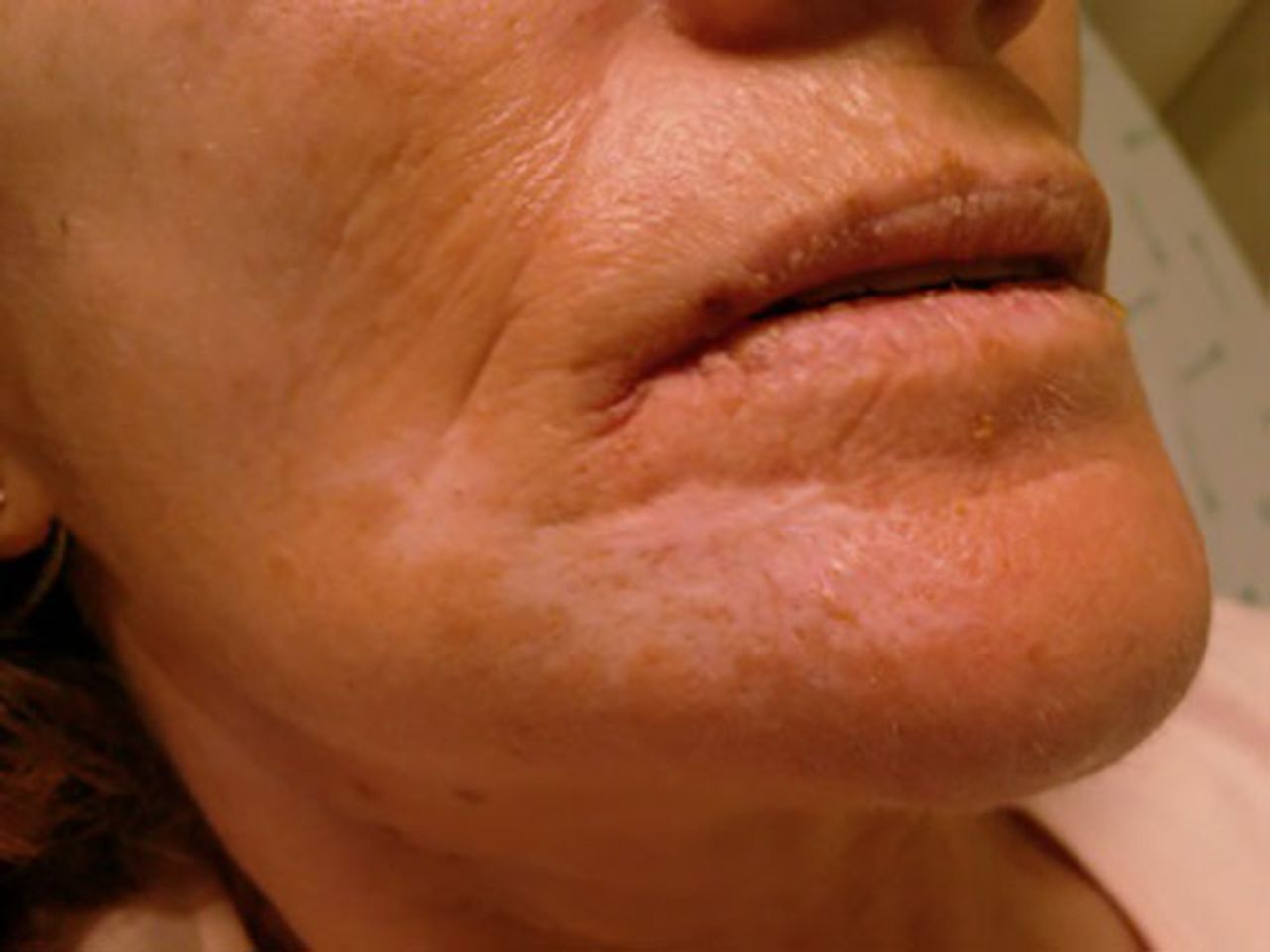 پلی آرتریت ندوزا