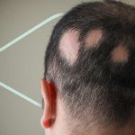 آلوپسی آره آتا