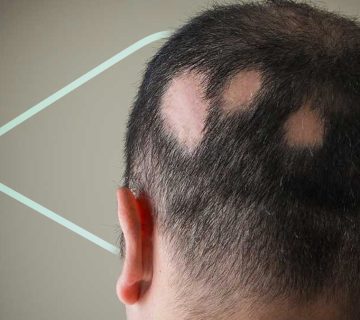 آلوپسی آره آتا