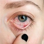 اسکلریت و یووئیت