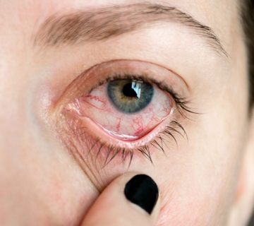 اسکلریت و یووئیت