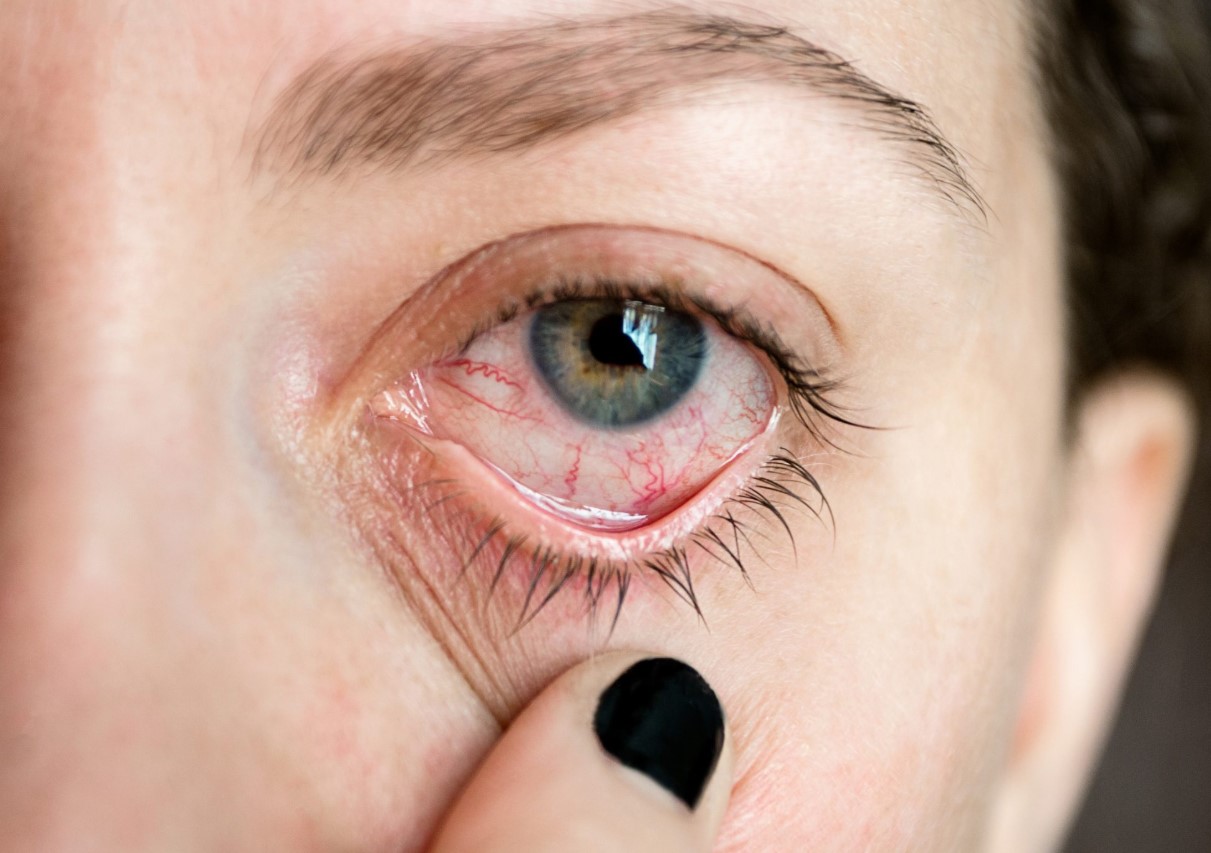 اسکلریت و یووئیت