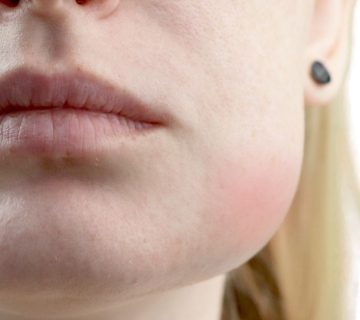 تورم غدد لنفاوی در اطراف صورت