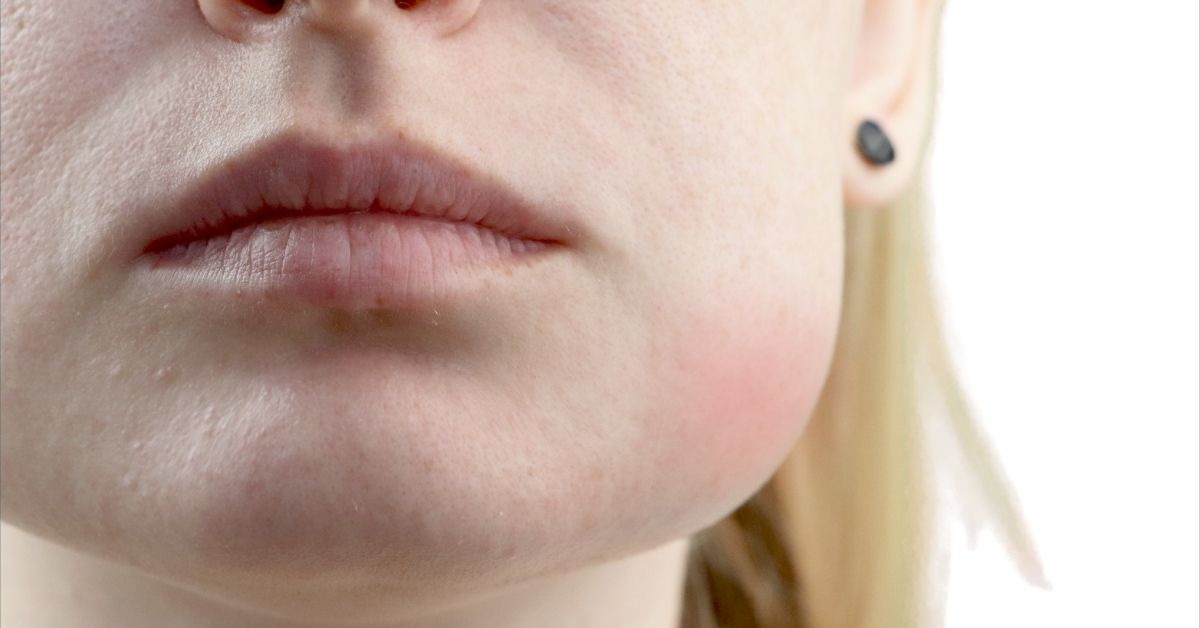 تورم غدد لنفاوی در اطراف صورت