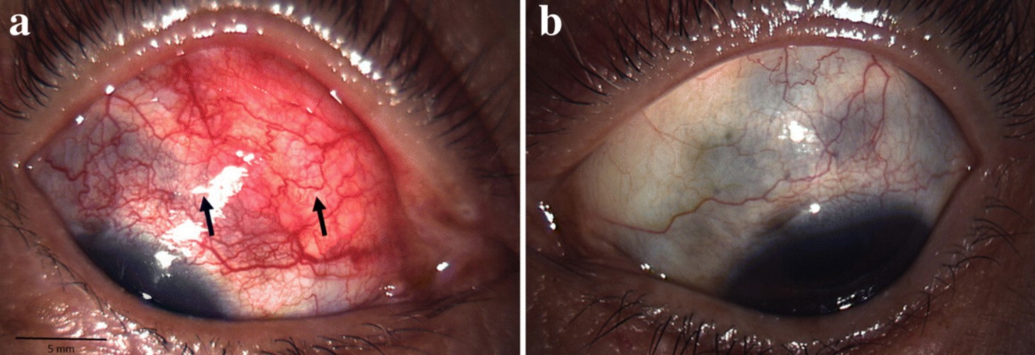 عکس اسکلریت و یووئیت