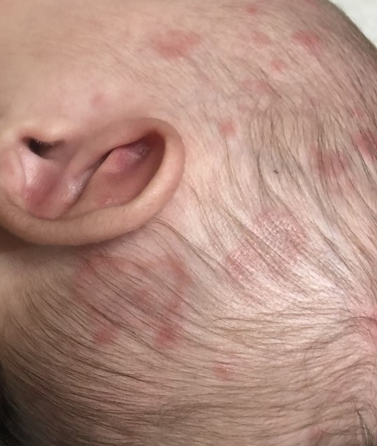 عکس لوپوس نوزادی