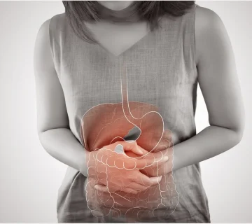 کولیت اولسراتیو