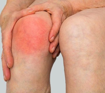 آرتریت ویروسی