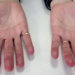 سندرم آنتی سنتتاز