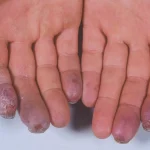 واسکولیت عروق کوچک و متوسط