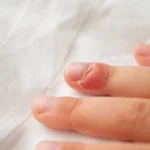 ورم انگشت دست بر اثر عفونت